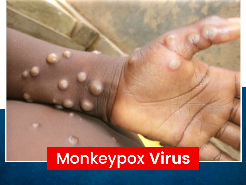 Monkeypox Virus Case Confirmed In UK, Read To Know All Details About This Virus